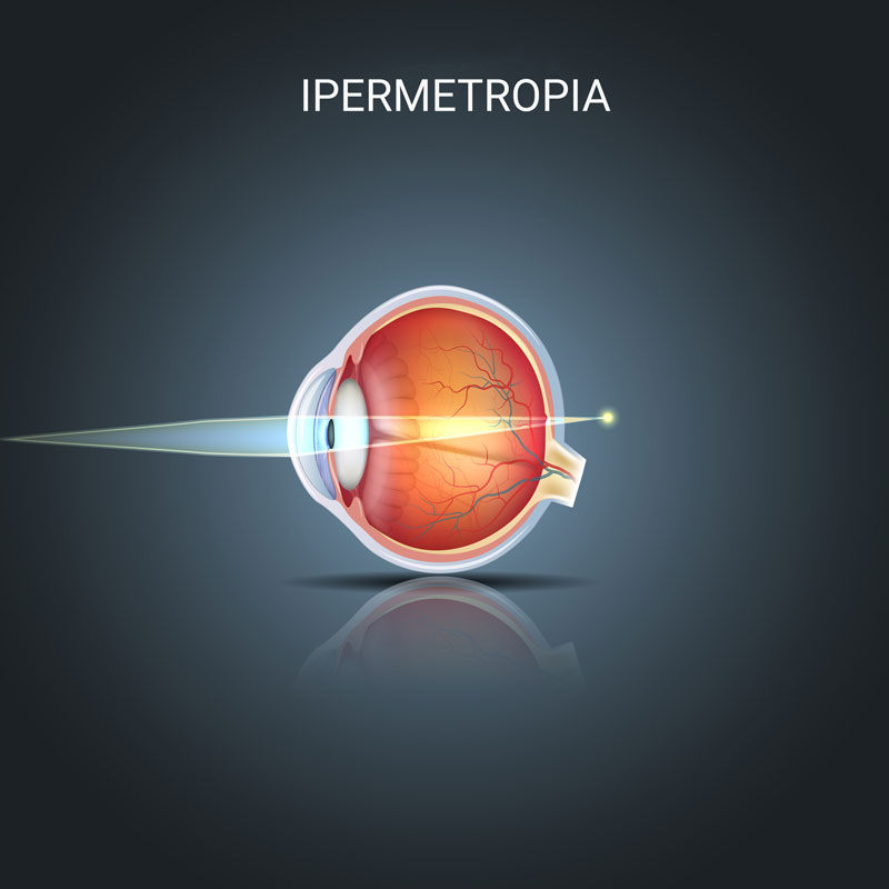 Ipermetropia: Cosa c'è da sapere