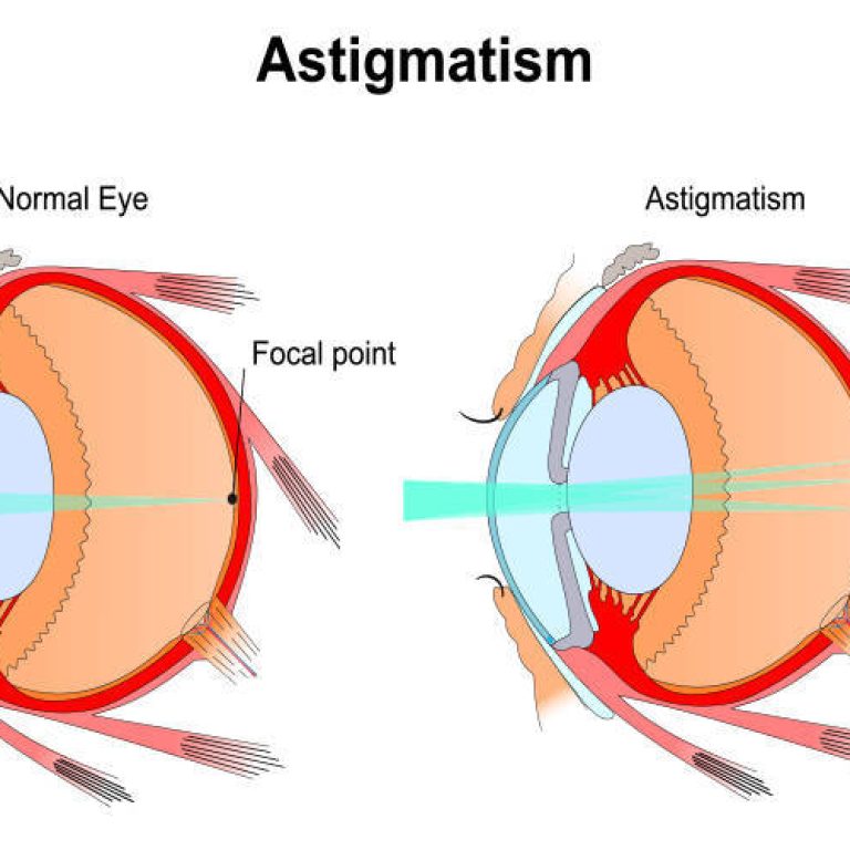 astigmatismo