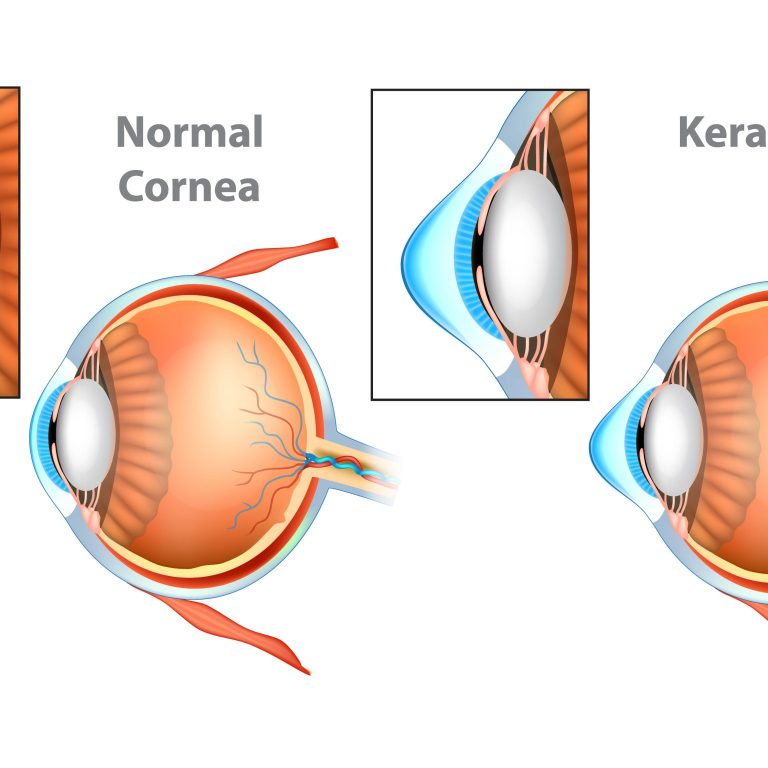 cheratocono-cornea