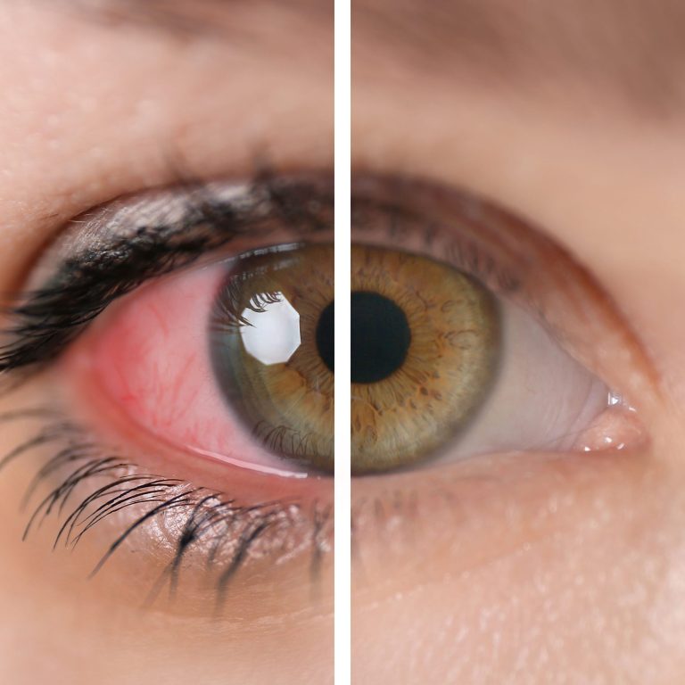 rimedi-occhi-arrossati